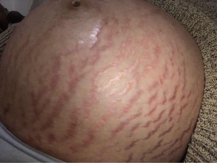 肚子妊娠线图片