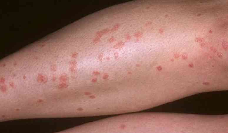 新冠病毒红疹皮疹图片图片