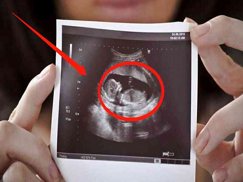 4个月男女胎儿区别图图片