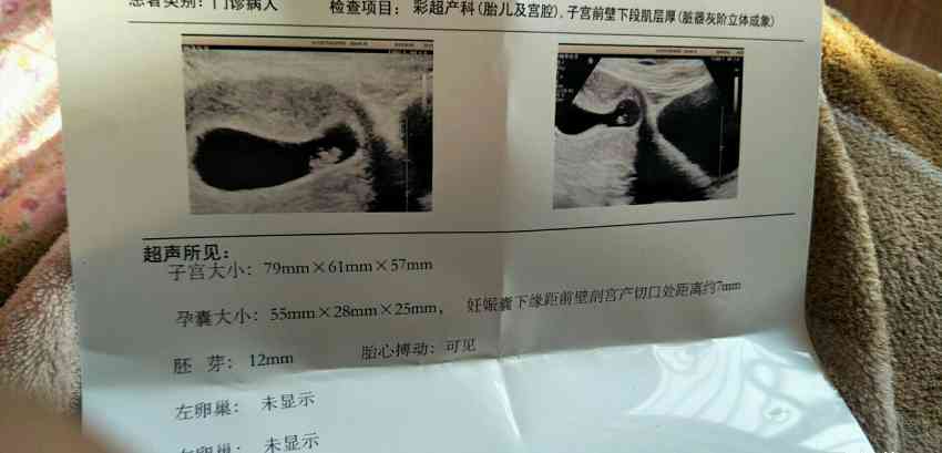 怀孕七周孕囊图片图片