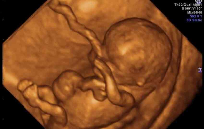 怀孕男孩妊娠线图片图片