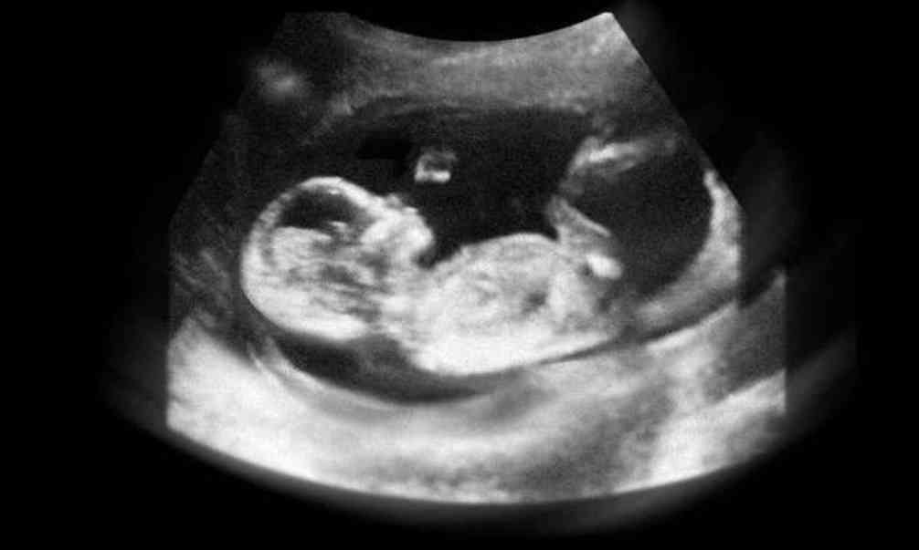 17周胎儿图片孕妇体型图片