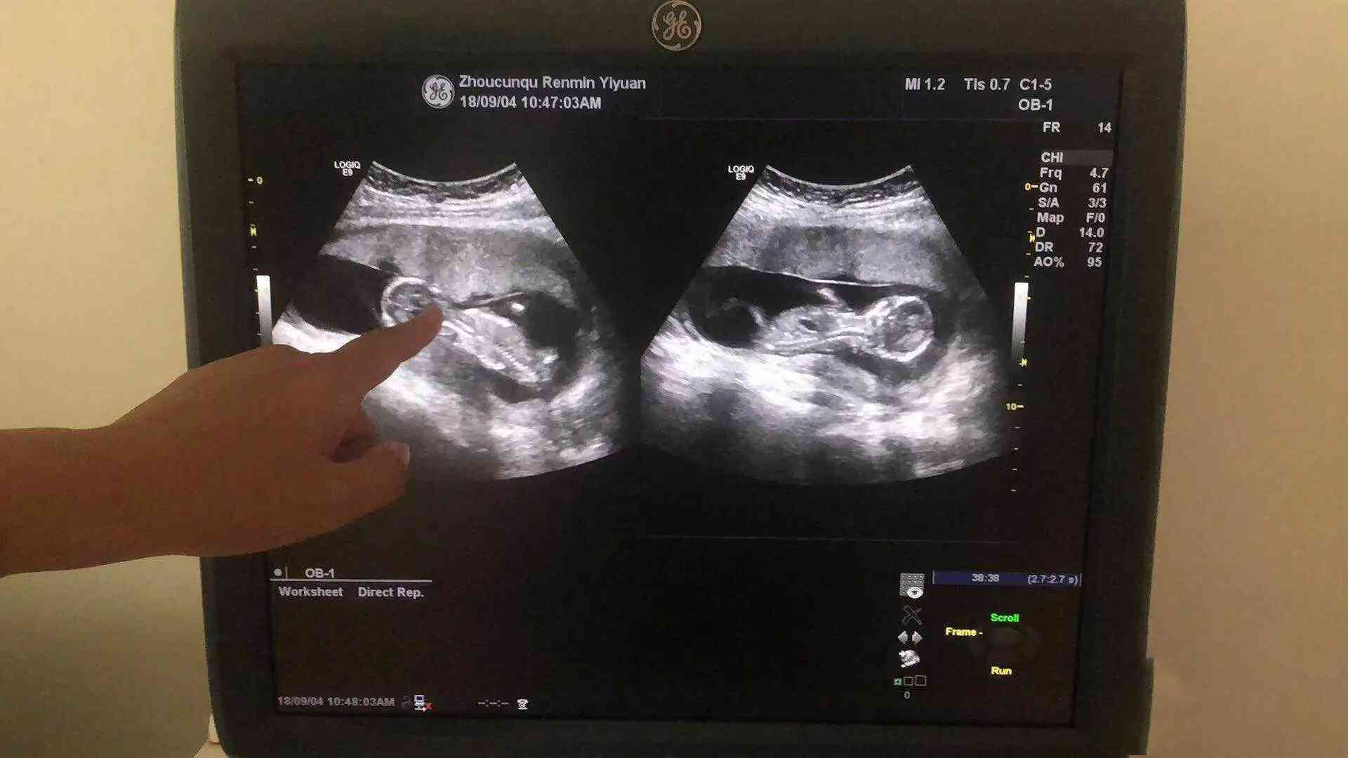 怀孕13周显怀图片图片