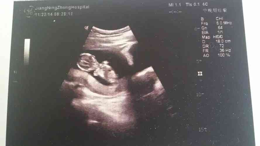 宝妈分享出怀孕10周胎儿真实图片原来宝宝已经发育成了这个样子