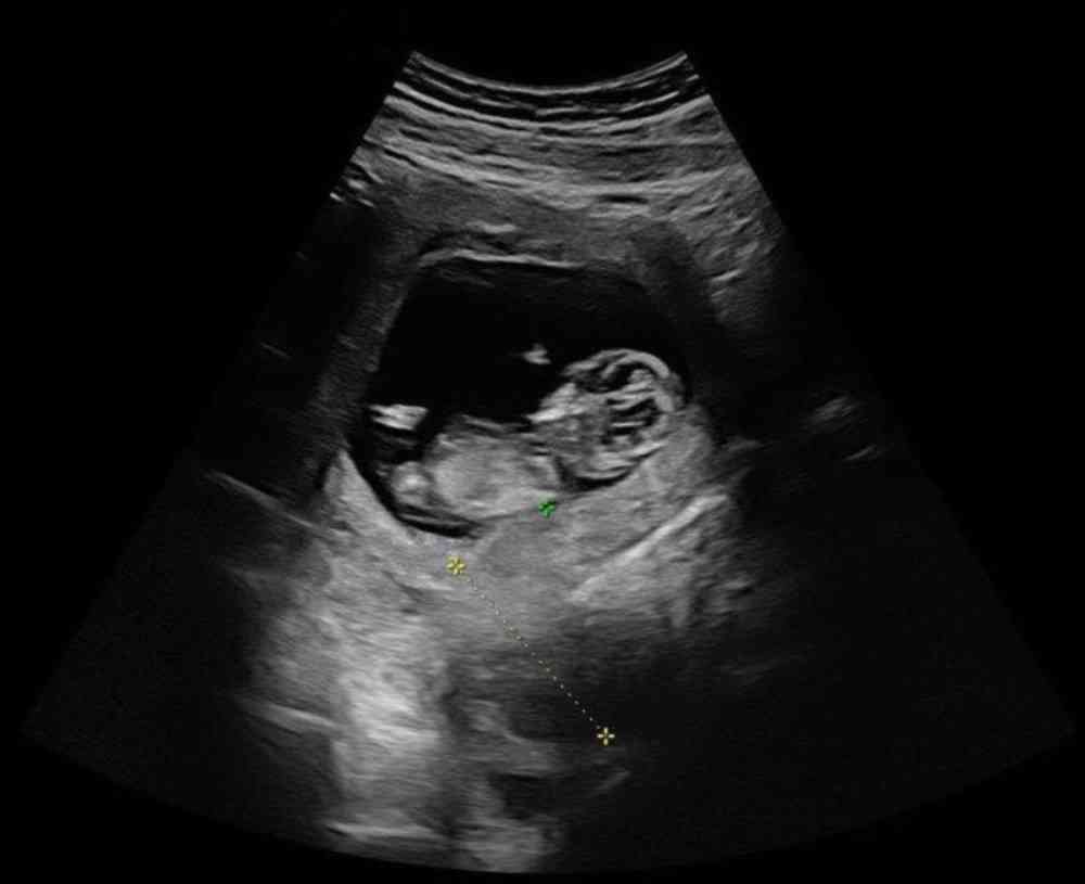 怀男孩的孕囊形状图片图片