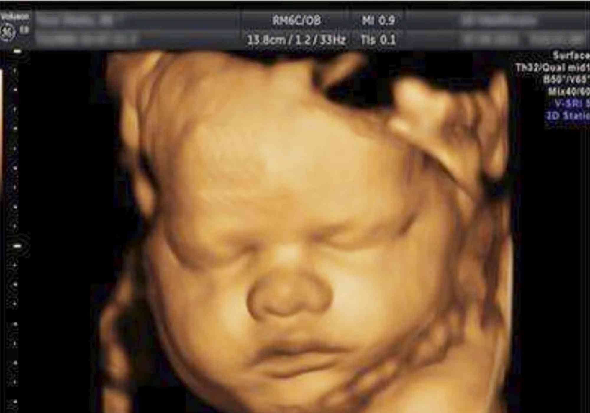 孕23周胎儿小鸡图图片