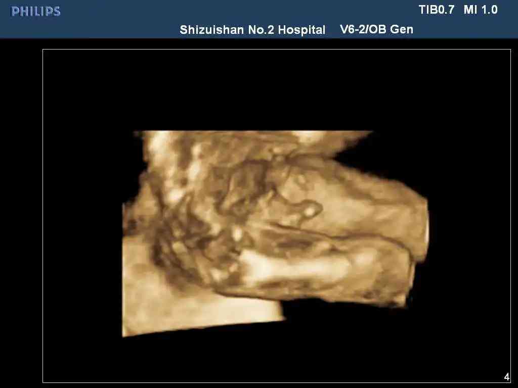 6个月男胎儿的睾丸图图片
