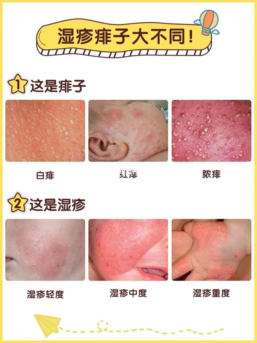 宝宝脸上湿疹和热疹的区别图片 ( 湿疹和热疹的区别图片)