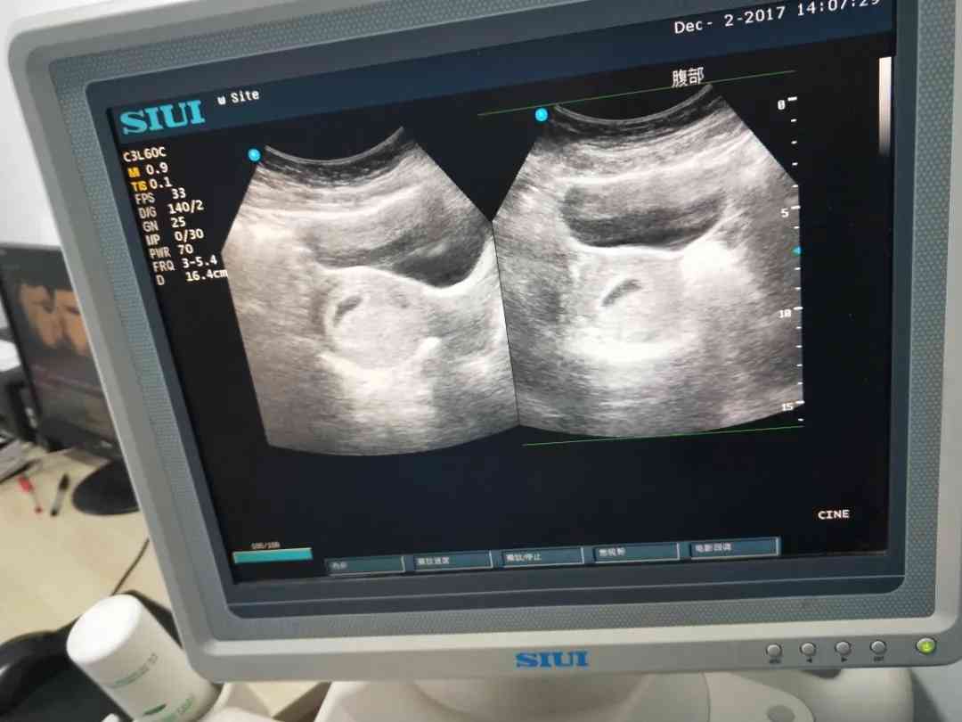 怀孕45天男孩胎囊图片图片