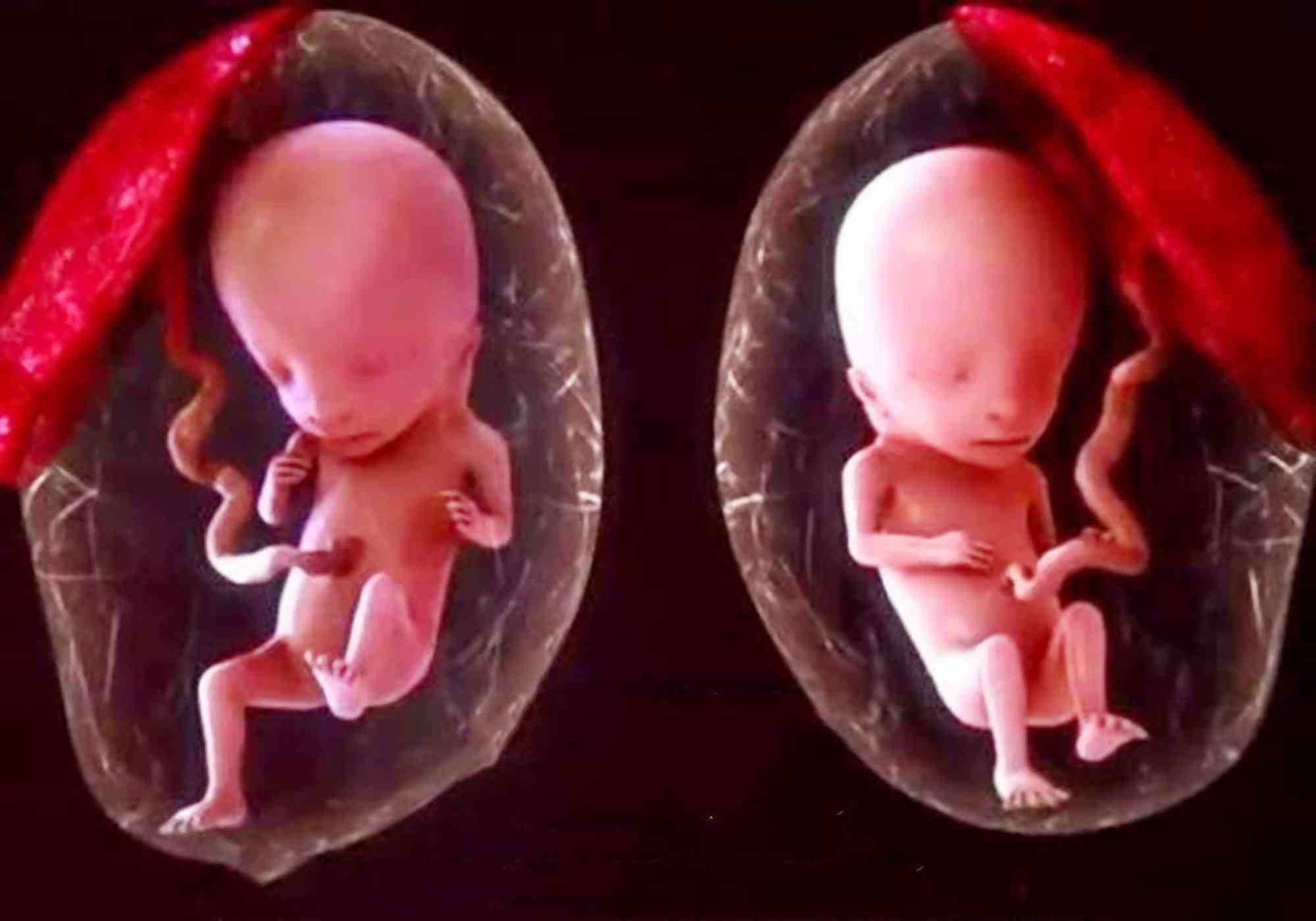 怀孕29周3天查出胎儿一单脐动脉是单卵双胎还是异卵双胎