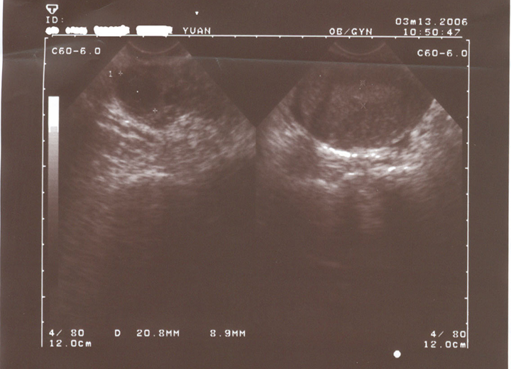 通过B超能诊断出子宫内膜息肉