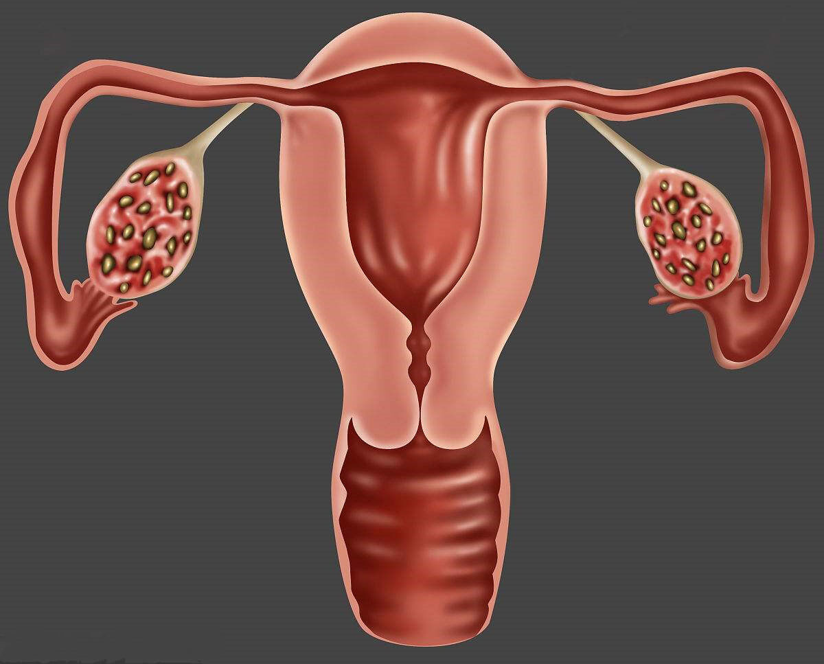 雄激素超过一定值会引起多囊卵巢