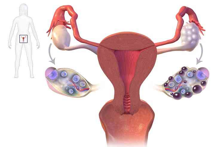 多囊卵巢综合症是什么造成的