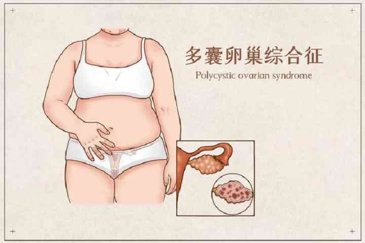 什么是多囊卵巢综合症