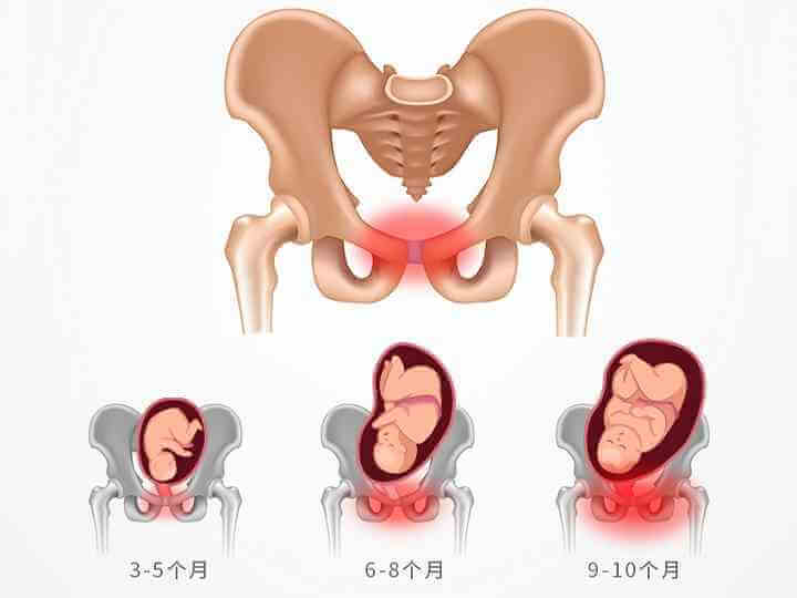 孕晚期孕妇耻骨疼痛