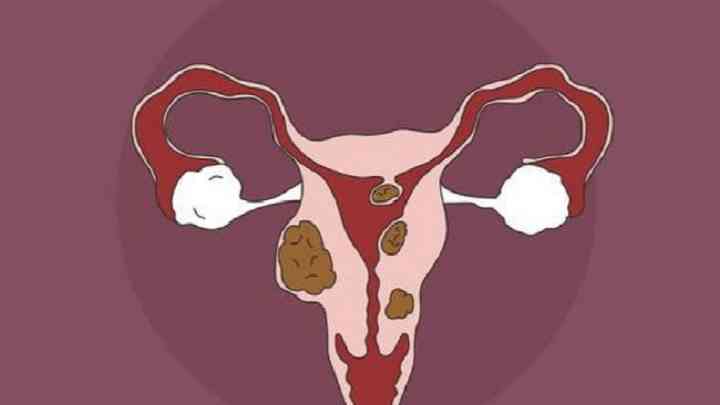 子宫肌瘤的临床表现