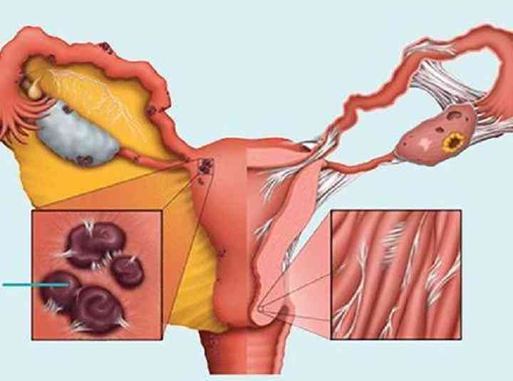子宫内膜异位症引起疼痛的原因
