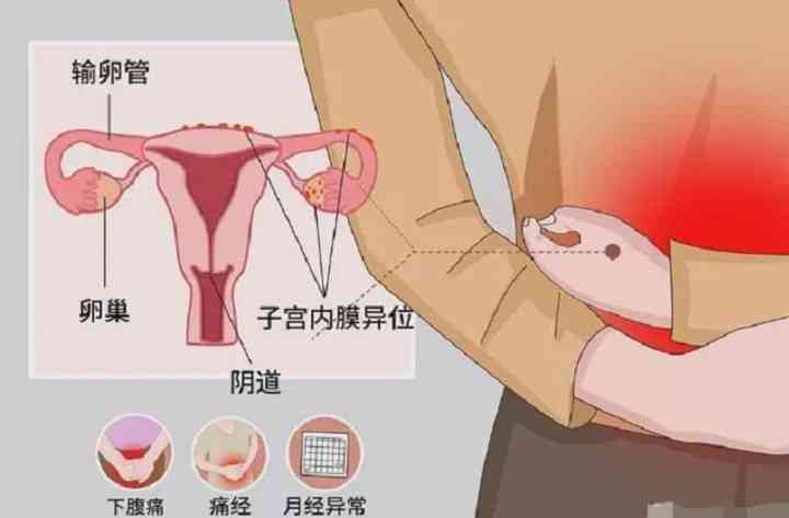 诊断子宫内膜异位症的方法