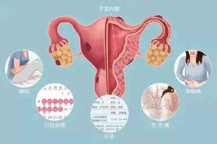 子宫内膜异位症可能出现哪些症状