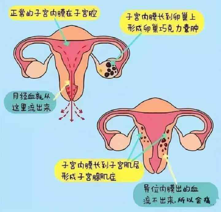 子宫内膜异位症有哪些
