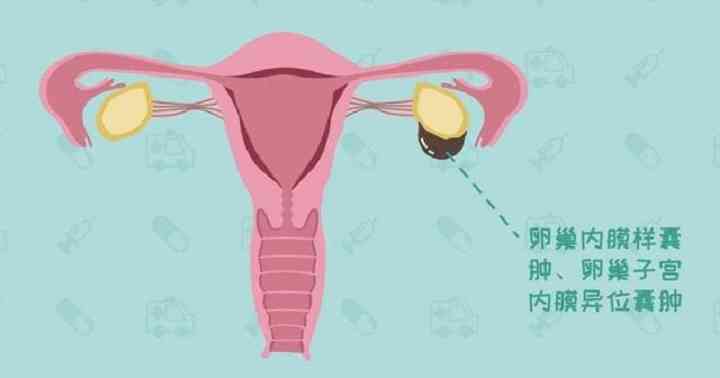 子宫内膜异位症会导致不孕