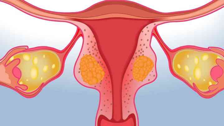 子宫肌瘤的病因是什么