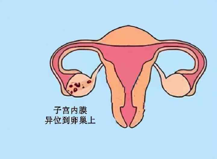 子宫内膜异位症的表现