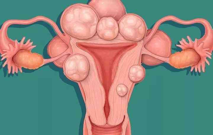 子宫肌瘤检查的常用手段是什么