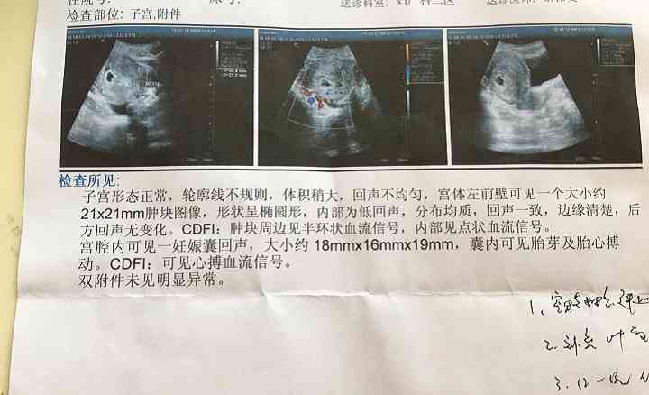 子宫肌瘤手术大概需要多少钱