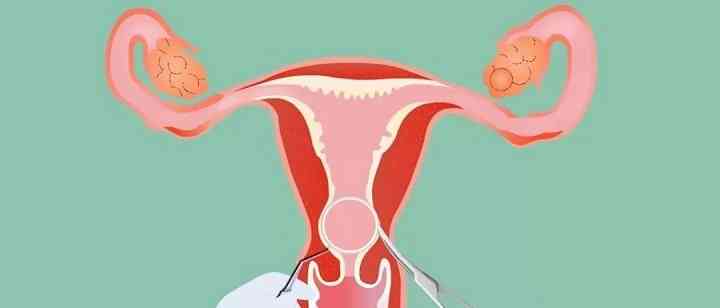 子宫腺肌症可以怀孕吗