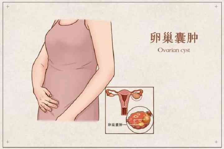 卵巢囊肿患者可以怀孕