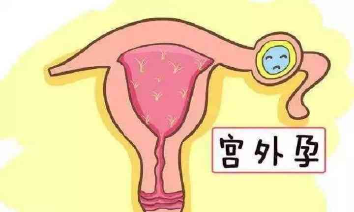 宫外孕会导致孕期出血