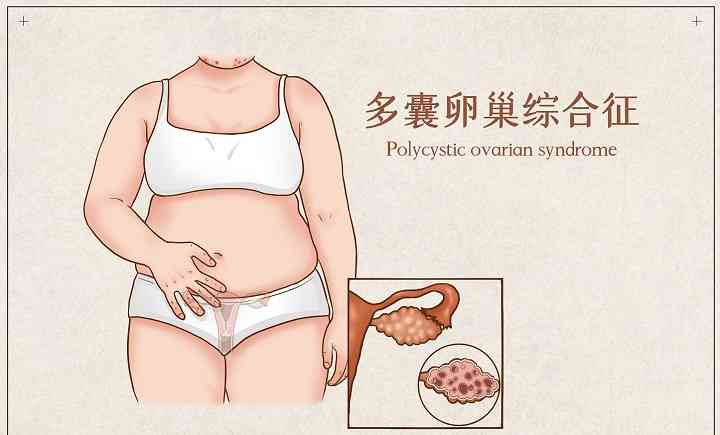 多囊卵巢综合征怎么看