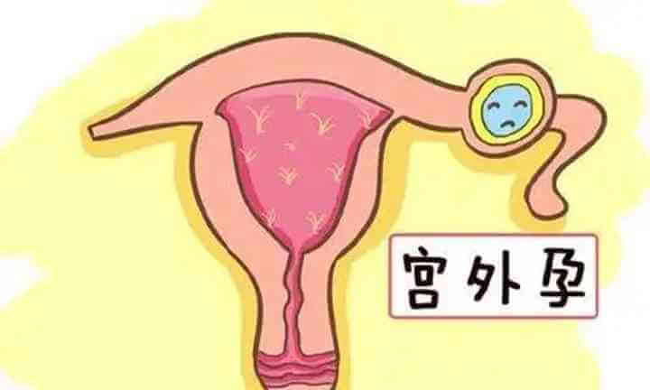 宫外孕引起的腹痛措施