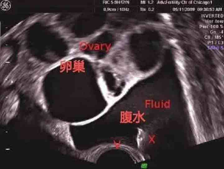取卵后可能会有腹水的发生