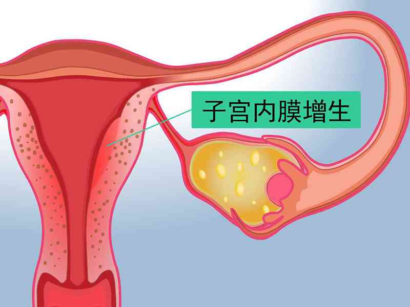子宫内膜增生是可逆性的疾病