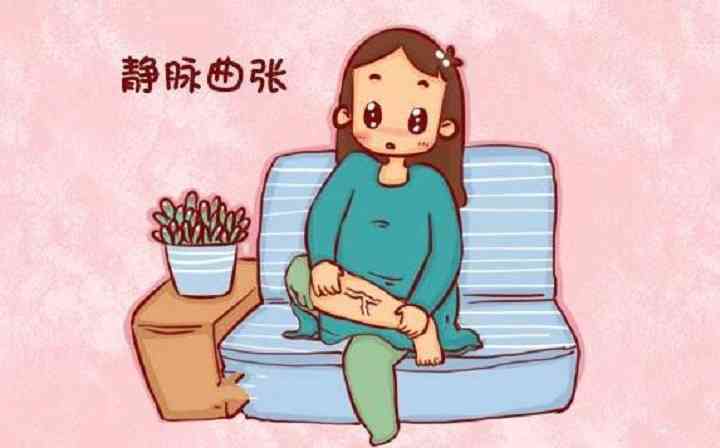 孕中期可能会出现静脉曲张
