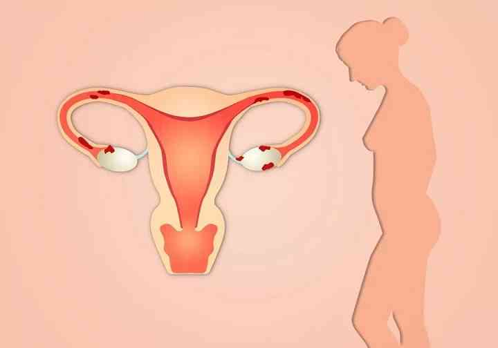 宫腔手术会导致子宫内膜炎