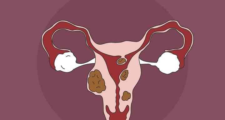 女性雌激素水平低下会导致子宫内膜炎