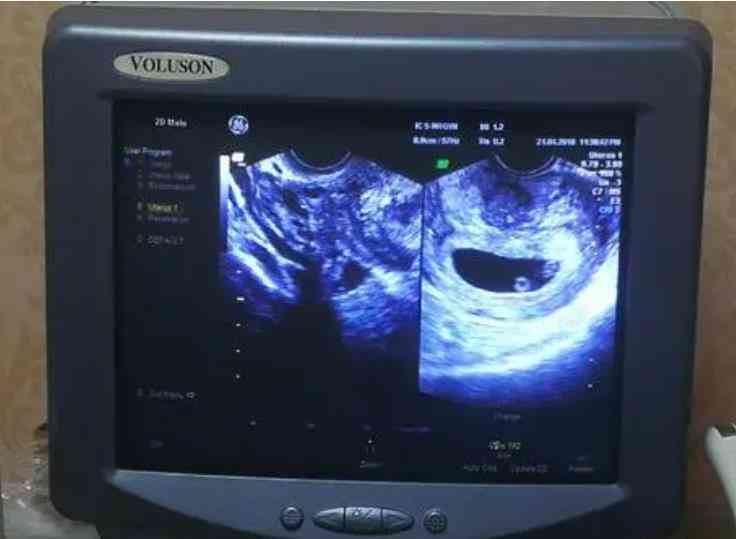 在怀孕49～56天左右可通过B超检测看到胎儿心跳