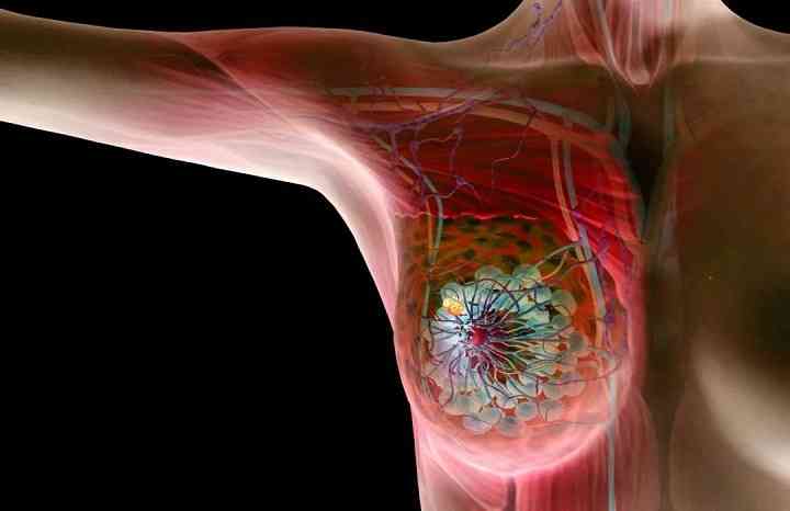 乳腺增生检查方法