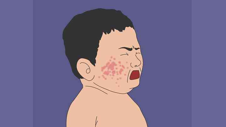 婴儿湿疹正确预防方法