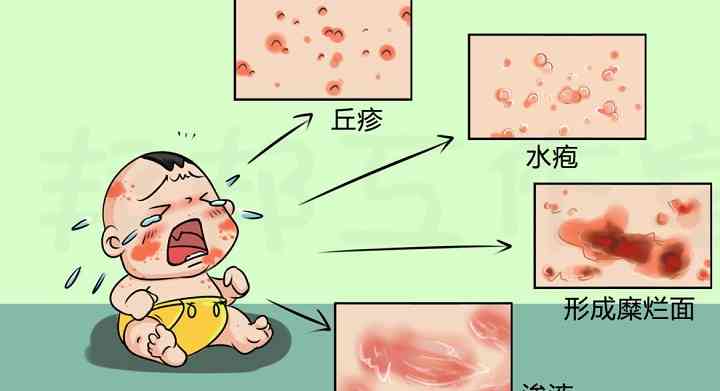婴儿湿疹渗出型症状