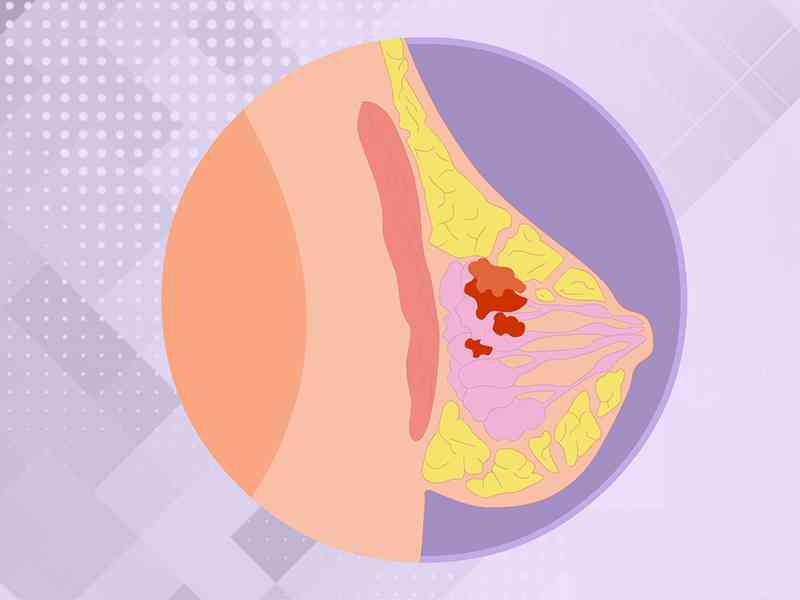 乳管阻塞会导致乳腺炎