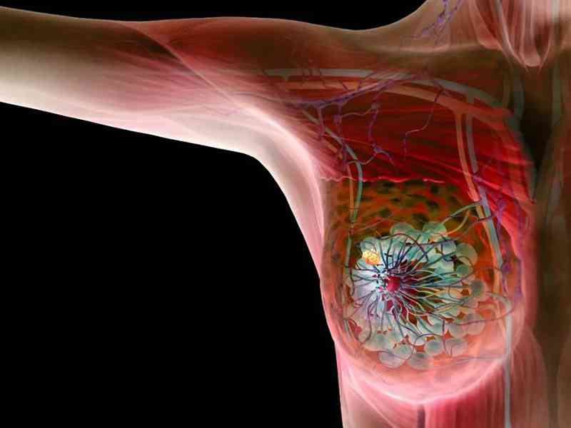 乳头内陷是乳腺纤维瘤的表现