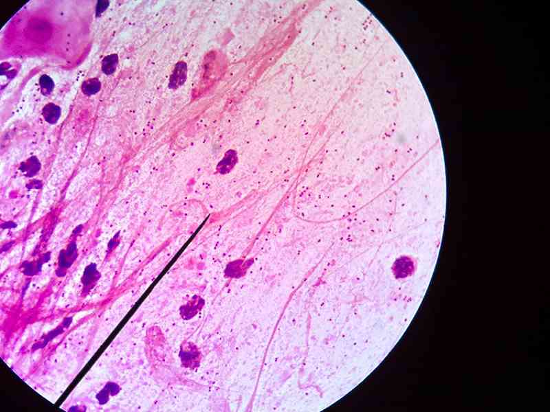 革兰阴性杆菌感染是肺炎最常见的原因