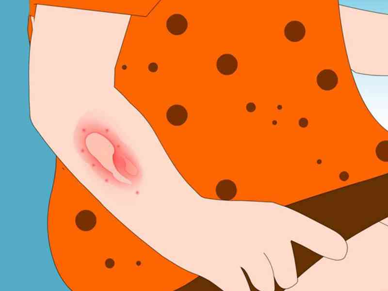 蓝芩口服液的过敏反应仅表现为过性皮肤瘙痒或荨麻疹等药疹，发生率低