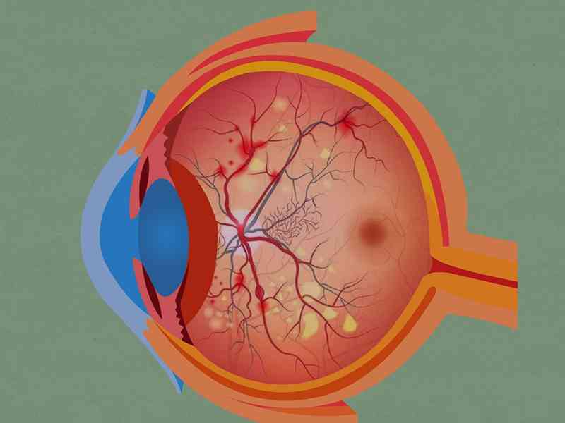 结膜炎会导致患者失明