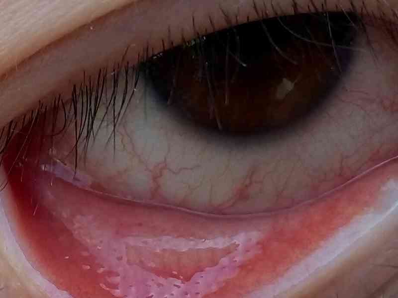 结膜炎的症状是非常明显的,大部分都会出现出现眼睛发红,干涩,眼痒