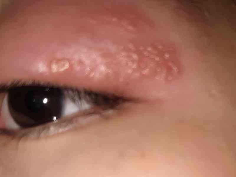 眼疱疹表现为水肿、淋巴结肿大